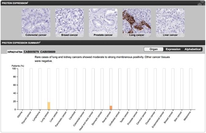 Antibody stainings from the 20 most common cancers performed for Aquaporin 4. Image from the Human Protein Atlas.