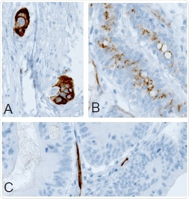 (A) Membranous, (B) non-membranous/cytoplasmic, and (C) absence of immunoreactivity in colorectal tumor samples following IHC staining with Anti-PODXL (AMAb90667) antibody.