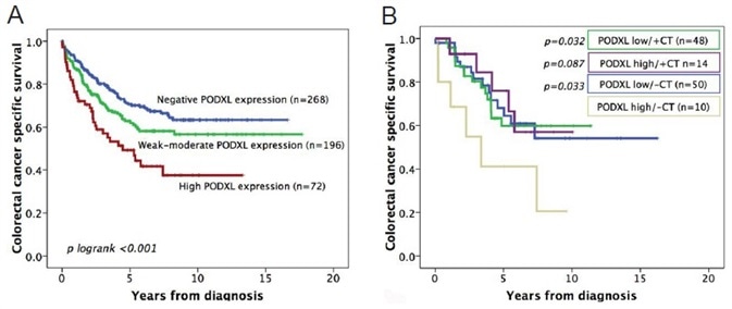 (A) Kaplan-Meier analysis of colorectal cancer-specific survival of patients with tumors expressing no, weak/moderate, or high levels of PODXL protein. (B) Kaplan-Meier analysis of colorectal cancer-specific survival, where patients are divided into groups according to whether they received adjuvant chemotherapy (CT) or not, as well as the level of tumor PODXL expression (high or low).