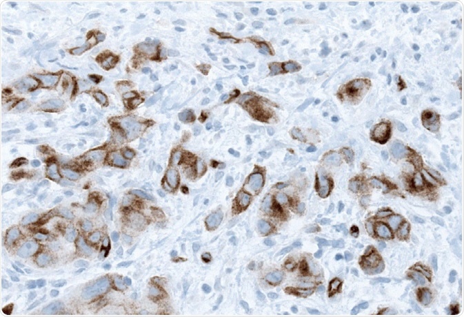 Membranous PODXL expression in urothelial cancer obtained by IHC analysis using the Anti-PODXL antibody AMAb90643.
