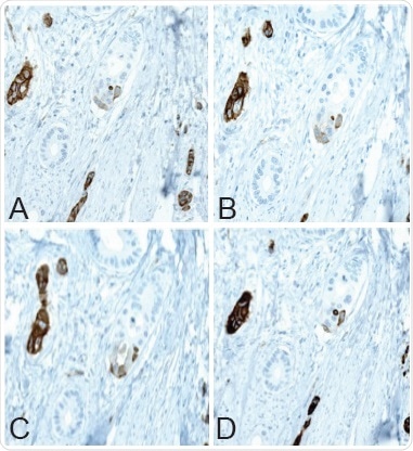 Immunohistochemical staining of PODXL protein in colorectal tumor tissue using (A) HPA002110, (B) AMAb90643, (C) AMAb90644, and (D) AMAb90667 antibodies.