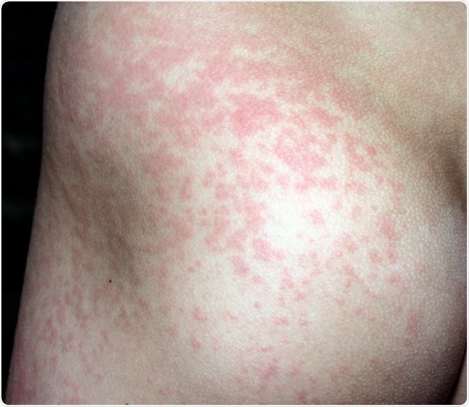 The rash from fifth disease on a child. Image Credit: weakiva / Shutterstock