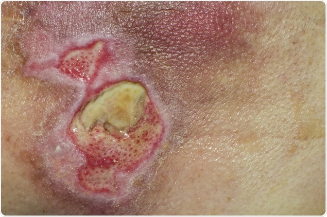 Serious open wound on a skin. Image Credit: Ciolanescu / Shutterstock