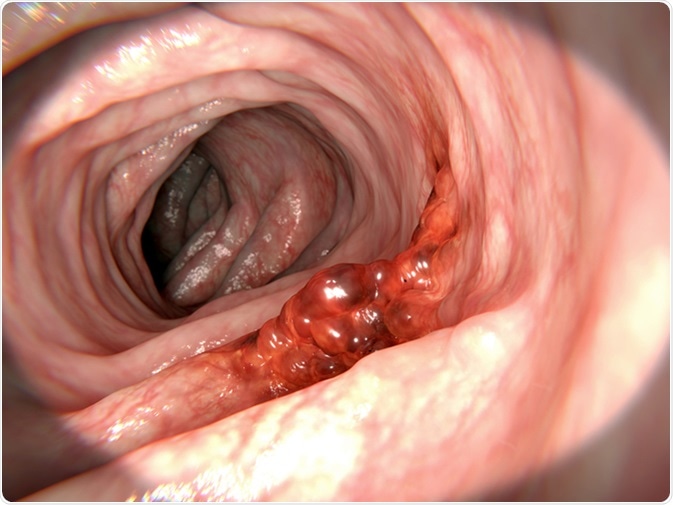 Colorectal cancer 3d rendering. Image Credit: Juan Gaertner / Shutterstock