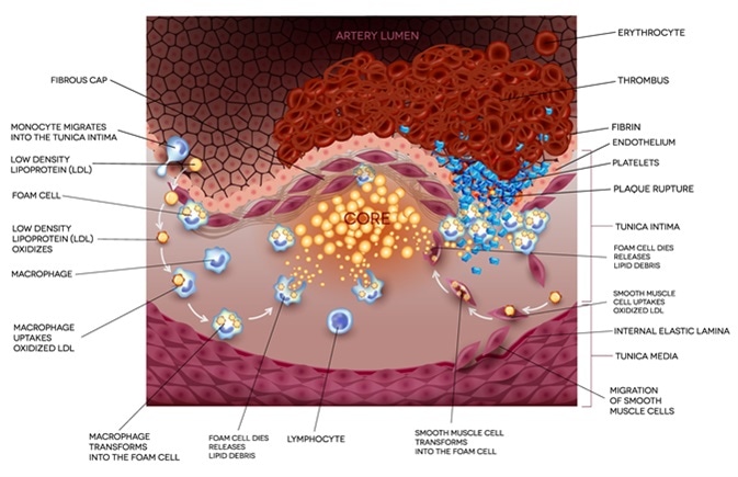 Ischemic stroke in the cerebral artery. Unstable plaque formation and thrombus. Image Credit: Tefi / Shutterstock Ischemic stroke in the cerebral artery. Unstable plaque formation and thrombus. Image Credit: Tefi / Shutterstock