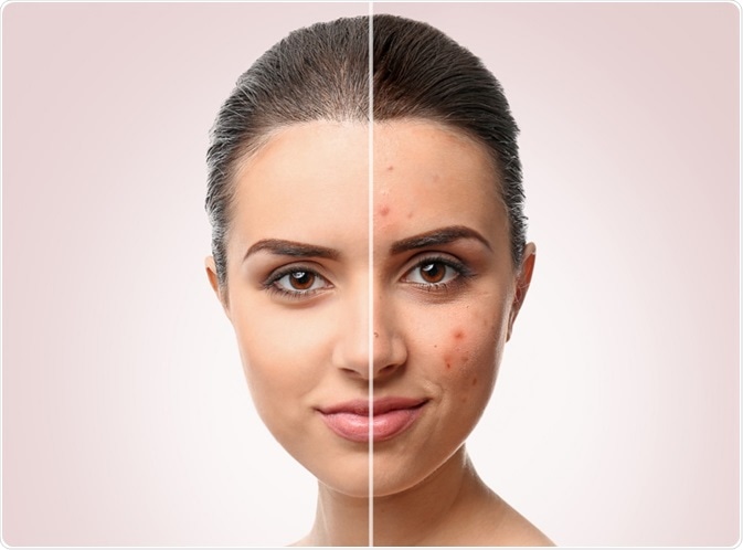 Woman with acne - by Africa Studio