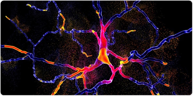 Degeneration of dopaminergic neuron, a key stage of development of Parkinson's disease, 3D illustration. Image Credit: Kateryna Kon / Shutterstock
