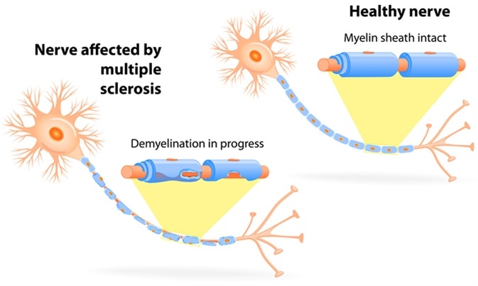 Nerve affected by multiple sclerosis. Image Credit: Designua / Shutterstock