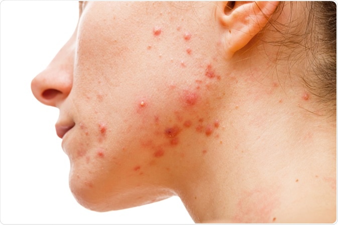 Acne skin. Image Credit: Ocskay Bence / Shutterstock