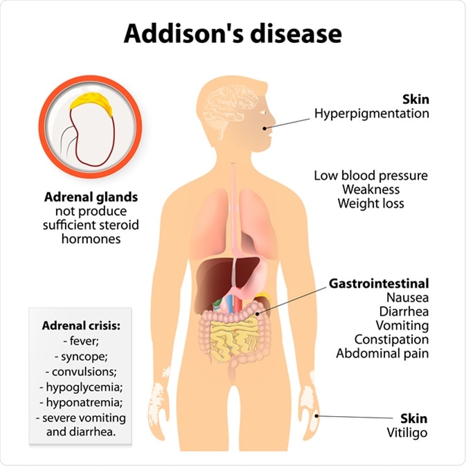 Addison's disease or chronic adrenal insufficiency signs and symptoms. Image Credit: Designua / Shutterstock