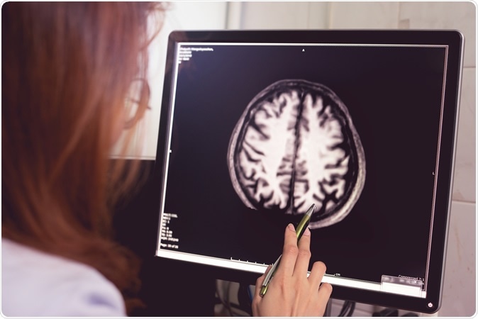 MRI brain of Dementia patient with left parietal atrophy asymmetry. Shutterstock / Atthapon Raksthaput