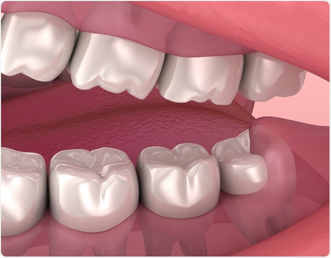 Wisdom teeth - By Alex Mit