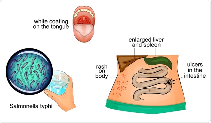 Symptoms of typhoid fever Symptoms of typhoid fever