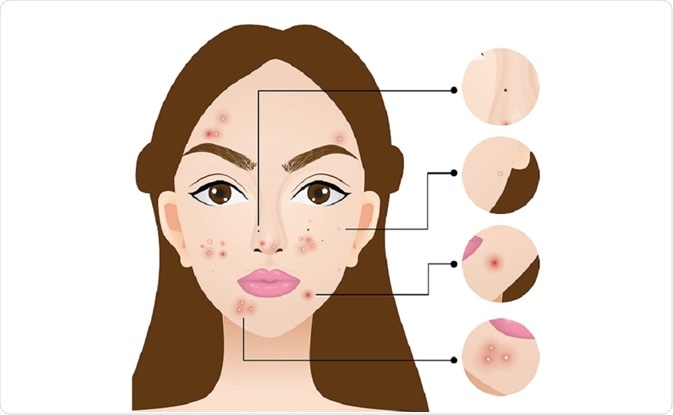 Illustration of woman showing the types of spots that can occur in acne - by charless