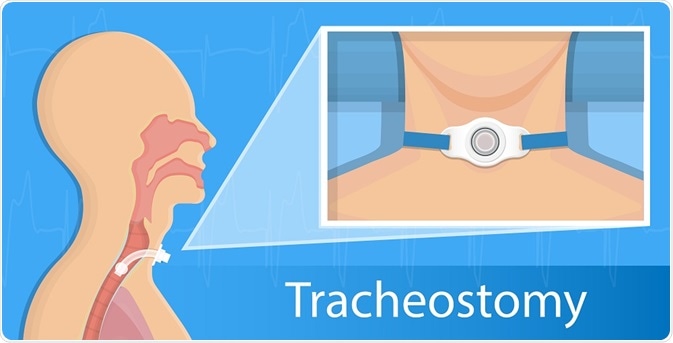 Diagram illustrating a tracheostomy - By rumrua