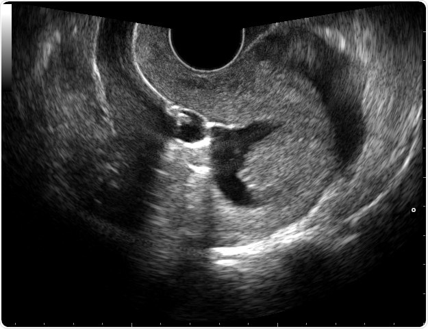 Sonohysterography. Sonohysterography is a technique to image the uterine cavity. Sterile saline is infused through a catheter to distend the uterine cavity. This allows seperation of contours of endometrium from the pathology. Attribution: © Nevit Dilmen