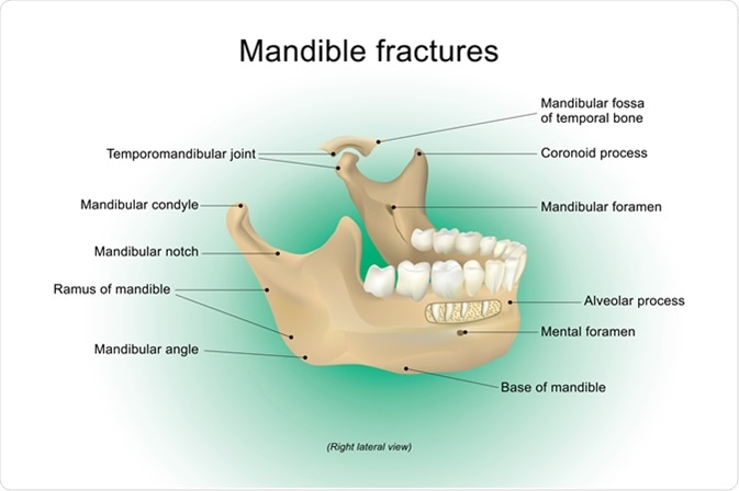Mandibular fracture, also known as fracture of the jaw, is a break through the mandibular bone. It may result in a decreased ability to fully open the mouth. Image Credit: Studio BKK / Shutterstock