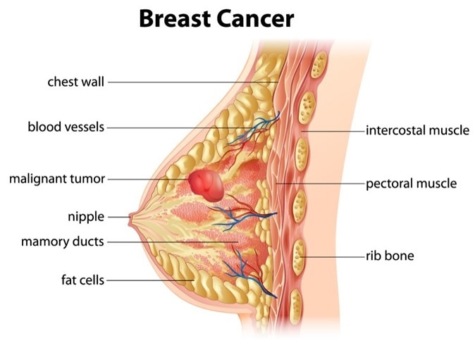 Cross section showing formation of breast cancer. Image Credit: BlueRingMedia / Shutterstock