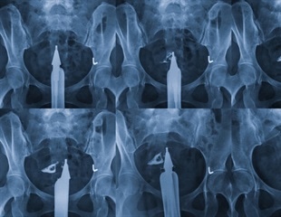 What is Hysterosalpingography?