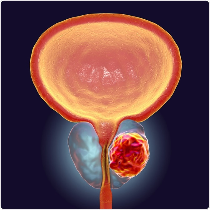 Prostate cancer, 3D illustration showing presence of tumor inside prostate gland which compresses urethra. Image Credit: Kateryna Kon / Shutterstock