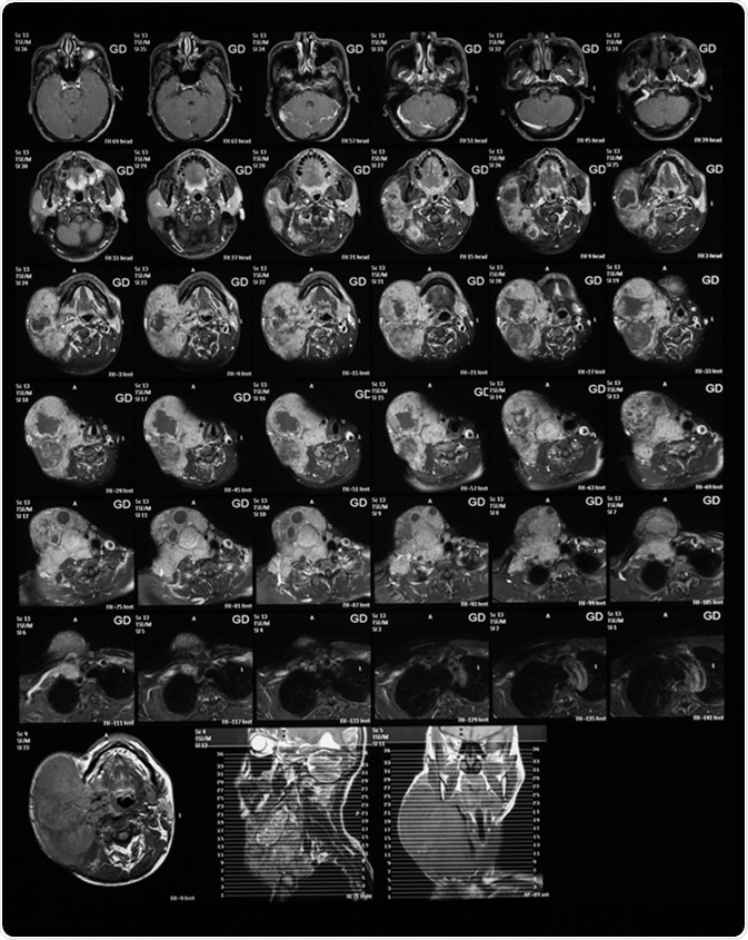 Magnetic resonance imaging of the neck with Gadolinium (GD) contrast agents, case of large right neck mass, mocoepidermoid carcinoma. Image Credit: Suttha Burawonk / Shutterstock