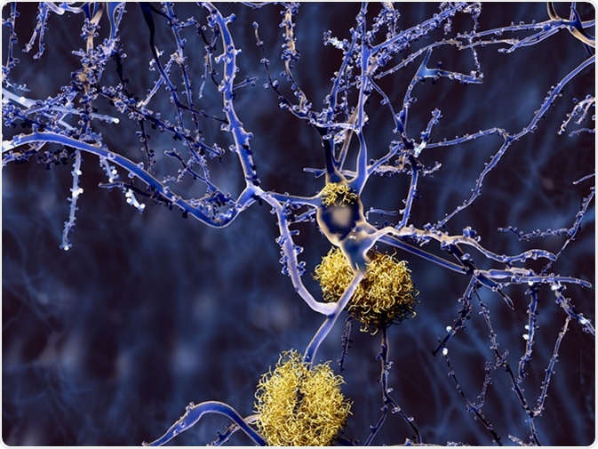 Alzheimer disease: neuron with amyloid plaques. Image Credit: Juan Gaertner / Shutterstock Alzheimer disease: neuron with amyloid plaques. Image Credit: Juan Gaertner / Shutterstock