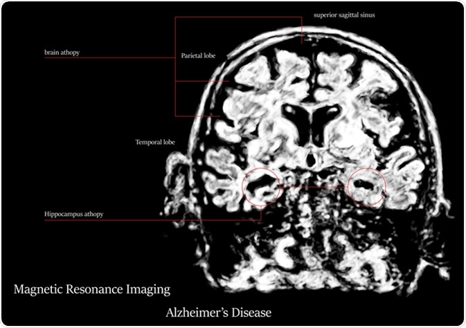 Alzheimer's disease MRI. Image Credit: Atthapon Raksthaput / Shutterstock Alzheimer's disease MRI. Image Credit: Atthapon Raksthaput / Shutterstock
