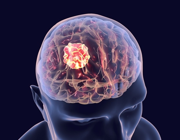 Study may lead to new therapeutic methods for treating aggressive brain cancer Study may lead to new therapeutic methods for treating aggressive brain cancer