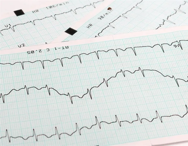 Noninvasive radiation therapy offers new hope for patients with high-risk heart arrhythmias Noninvasive radiation therapy offers new hope for patients with high-risk heart arrhythmias