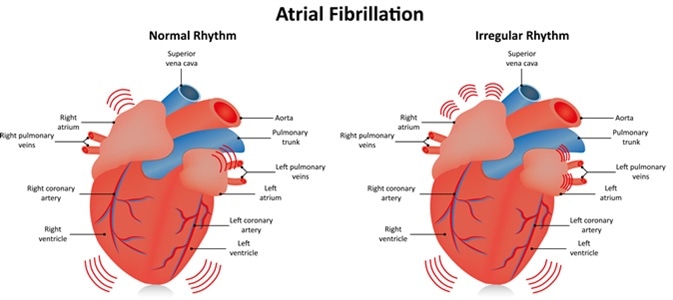 Atrial Fibrillation - Image Credit: Joshya / Shutterstock