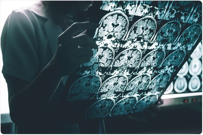 Alzheimer's disease on MRI. Image Credit: Atthapon Raksthaput / Shutterstock Alzheimer's disease on MRI. Image Credit: Atthapon Raksthaput / Shutterstock