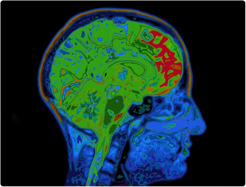 Brain scan with healthy green regions and red unhealthy regions