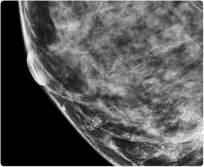 Microcalcifications in Breast
