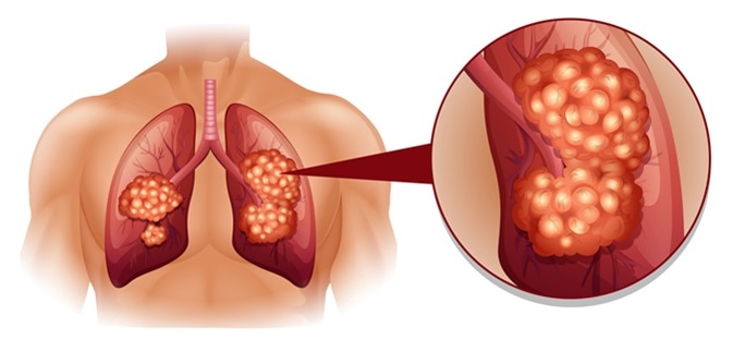 Lung cancer illustration. Image Credit: BlueRingMedia / Shutterstock