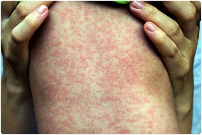 Measles rash: Image Credit: Phichet Chaiyabin / Shutterstock Measles rash: Image Credit: Phichet Chaiyabin / Shutterstock
