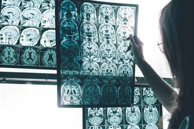 Alzheimer's disease on MRI. Image Credit: Atthapon Raksthaput / Shutterstock