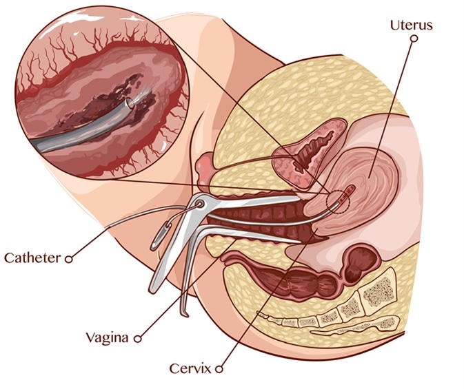 Endometrial biopsy. Image Credit: Corbac40 / Shutterstock