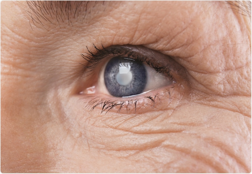 Elderly woman with cataracts