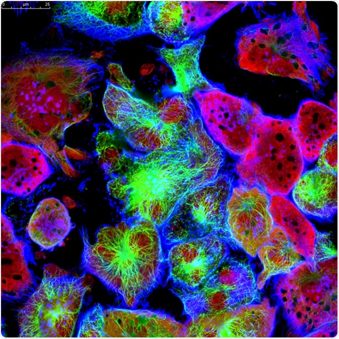 Tumor cells under microscope labeled with fluorescent molecules. Image Credit: Vshivkova / Shutterstock Tumor cells under microscope labeled with fluorescent molecules. Image Credit: Vshivkova / Shutterstock