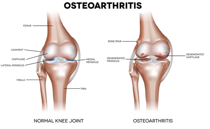 Knee Osteoarthritis and normal joint detailed anatomy. Image Credit: Nita_Nita / Shutterstock