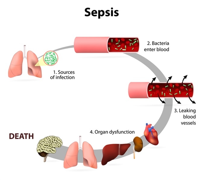 Sepsis or septicaemia is a life-threatening illness. Presence of numerous bacteria in the blood, causes the body to respond in organ dysfunction. Image Credit: Designua / Shutterstock