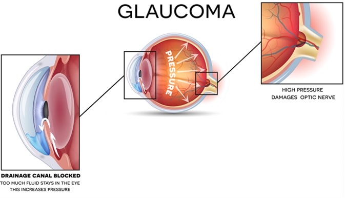 Glaucoma and healthy eye detailed structure. Image Credit: Tefi / Shutterstock Glaucoma and healthy eye detailed structure. Image Credit: Tefi / Shutterstock