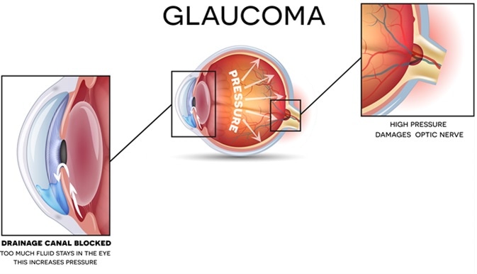 Glaucoma and healthy eye detailed structure. Image Credit: Tefi / Shutterstock