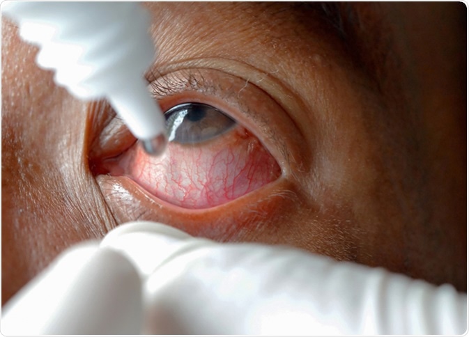 Close-up eye while doctor applying eye drop. Image Credit: Anukool Manoton / Shutterstock