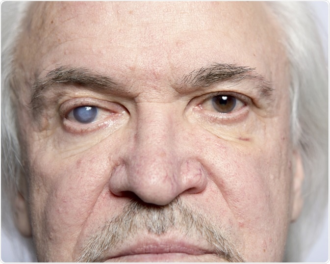 Patients with cataract and glaucoma. Image Credit: SERGEI PRIMAKOV / Shutterstock Patients with cataract and glaucoma. Image Credit: SERGEI PRIMAKOV / Shutterstock