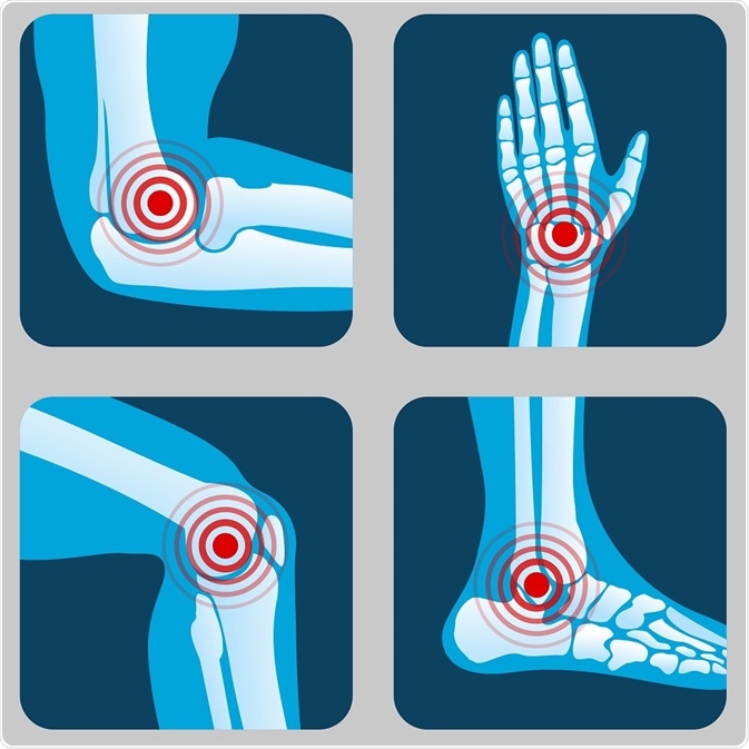 rheumatoid arthritis és osteoarthritis készítmények a nyaki gerinc osteochondrosisára