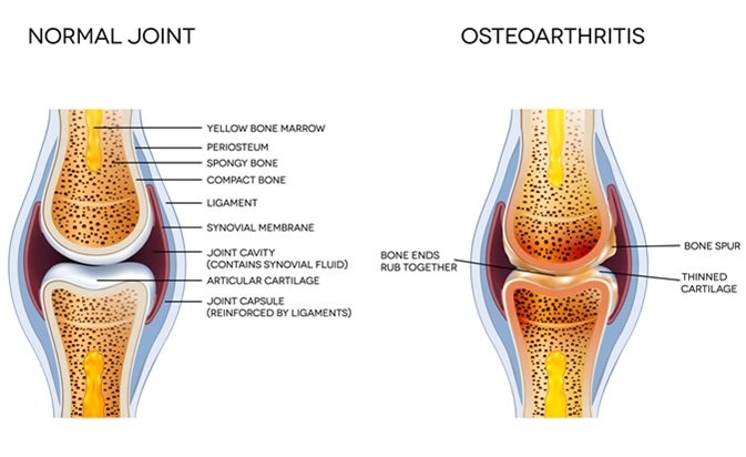 kenőcs osteoarthritis arthritises osteochondrosis esetén ízületi gyulladás kezelése 2 ujjal
