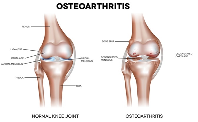 arthrosis osteophytes kezelés