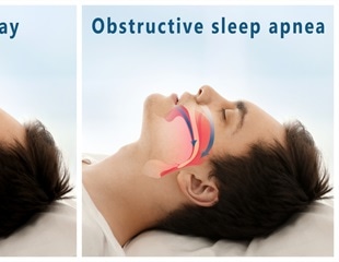 Hypoglossal Nerve Stimulation (HGNS) for Sleep Apnea