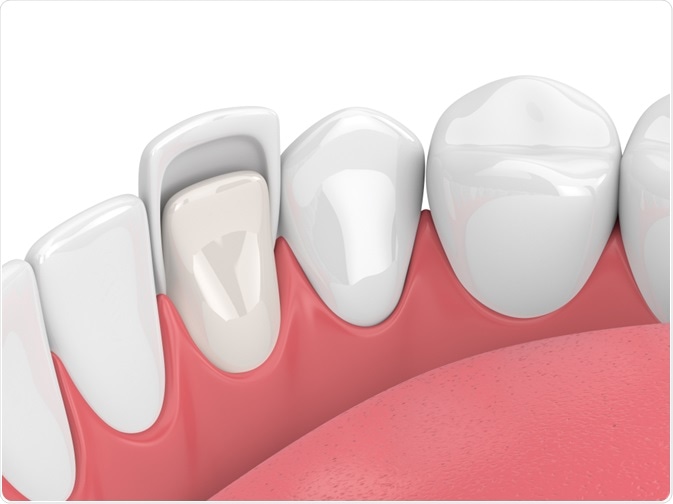 porcelain veneers currambine